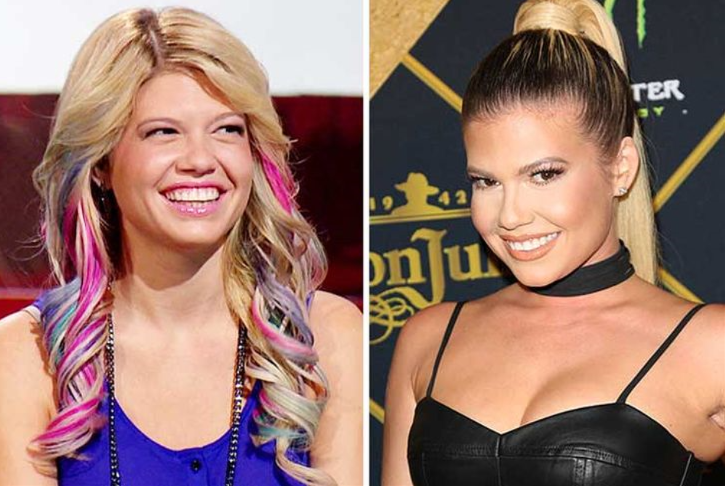 Chanel West Coast Teeth Before and After