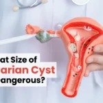 What Size of Ovarian Cyst is Dangerous