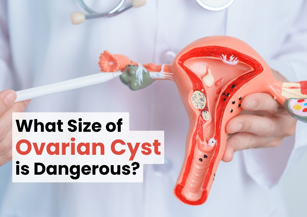 What Size of Ovarian Cyst is Dangerous