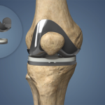 Knee Replacement Surgery