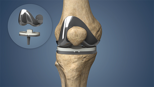 Knee Replacement Surgery