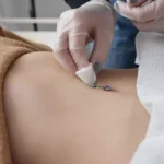 Evaluating the Belly Button Piercing Pain Scale 1-10