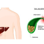 What Do Gallstones Look Like in the Toilet