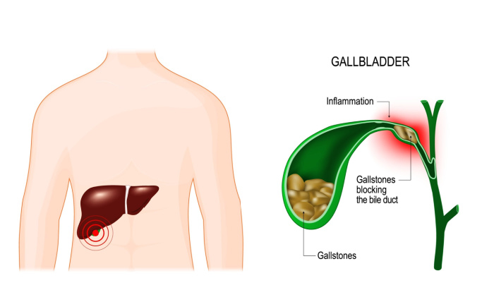 What Do Gallstones Look Like in the Toilet