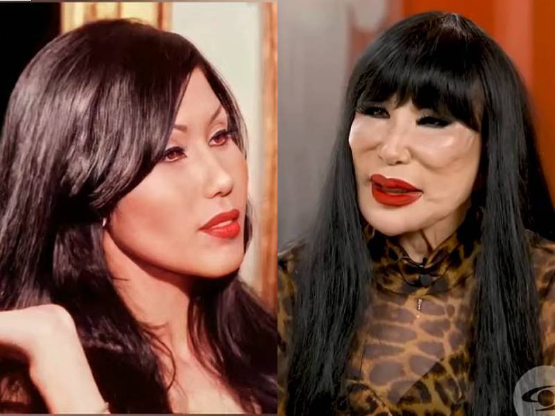 Lyn May Plastic Surgery : Let’s Reveal All about It!