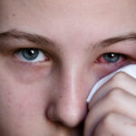 can a Stye Cause a Headache