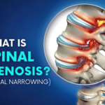 Spinal Stenosis