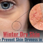 Prevent Skin Dryness in winter