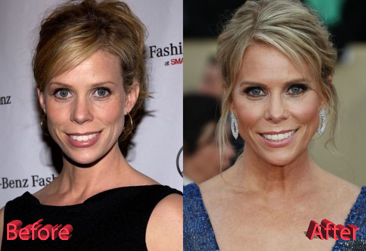 Cheryl Hines before and after Plastic Surgery