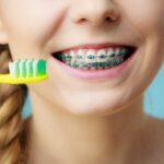 What Happens If You Don’t Brush Your Teeth with Braces?