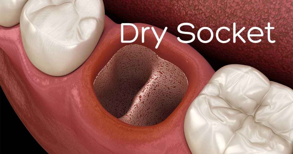 Risk of Dry Socket