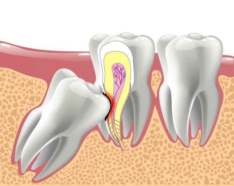 Understanding the Wisdom Teeth Removal Recovery Process