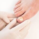 How Long Does It Take Bleach to Kill Toenail Fungus?