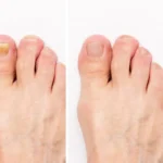 Pedicure with Toenail Fungus