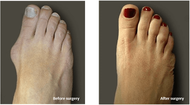 4 Weeks After Bunion Surgery