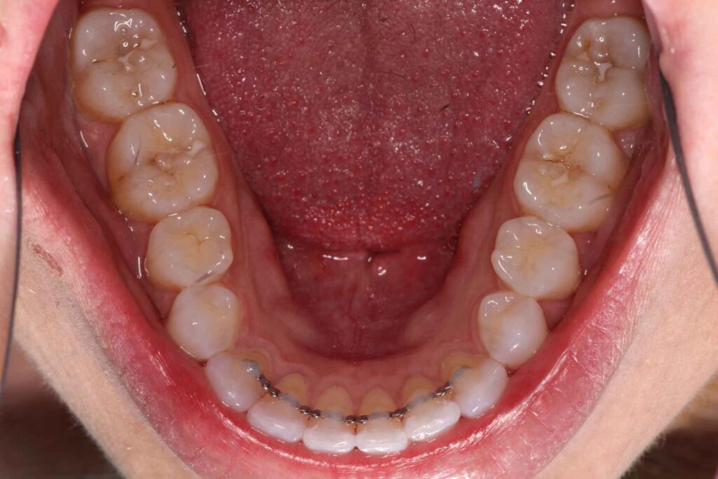 Behind the Lower Front Teeth (Near the Salivary Gland Ducts)