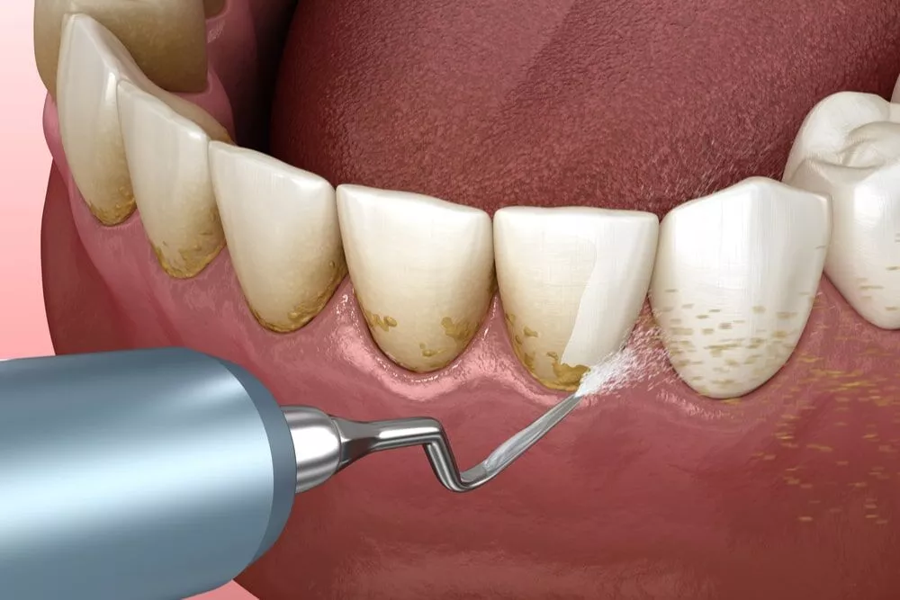 Dental Scaling