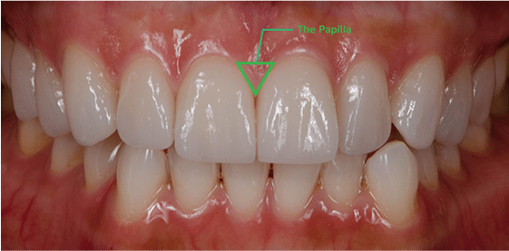 Gumline and Between Teeth