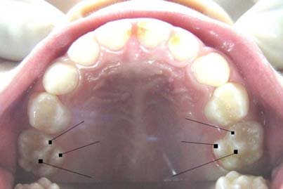 Outer Surfaces of Upper Molars