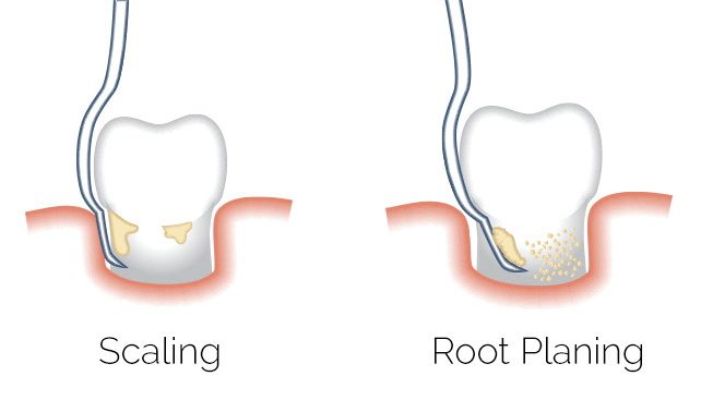 Root Planing