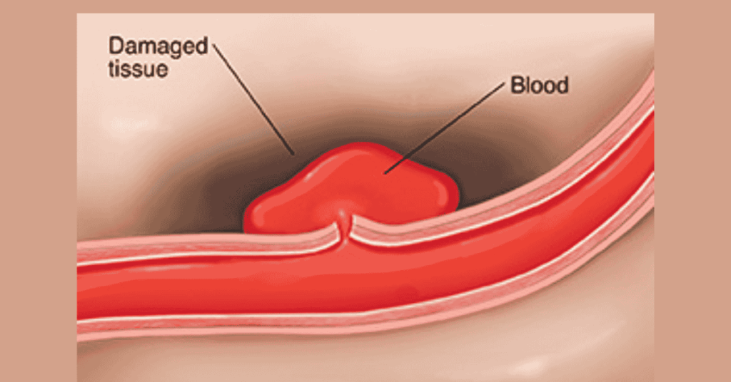 Blood Vessel Damage