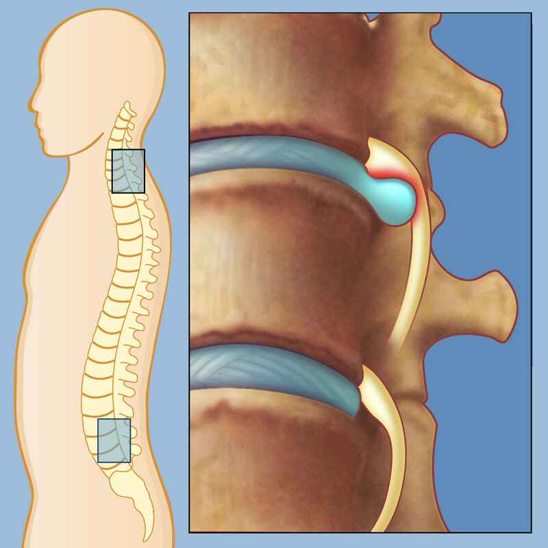 Herniated Disc