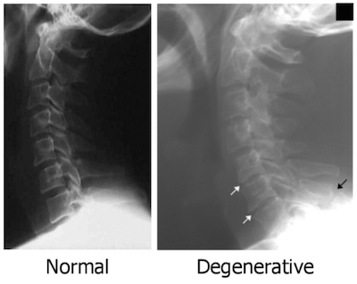 Cervical Spine Issues