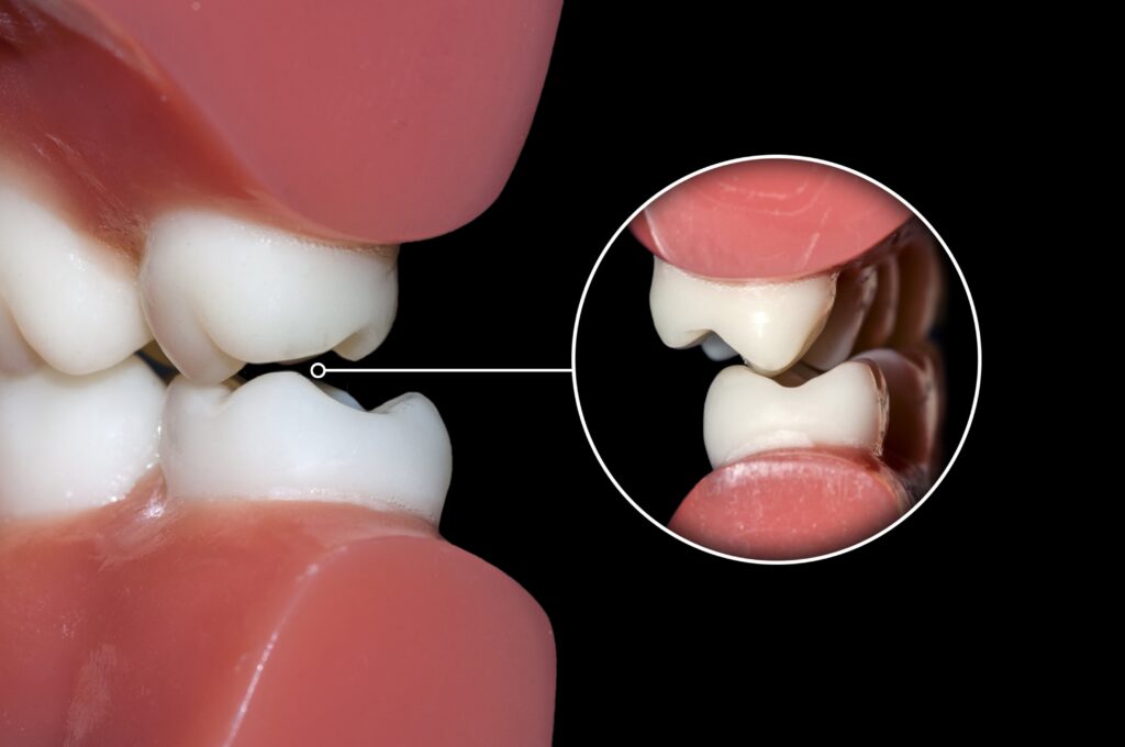 Teeth Grinding (Bruxism)