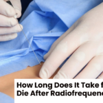 How Long Does It Take for Nerves to Die After Radiofrequency Ablation