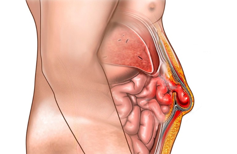 Abdominal Hernia