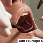 Can You Vape After a Filling