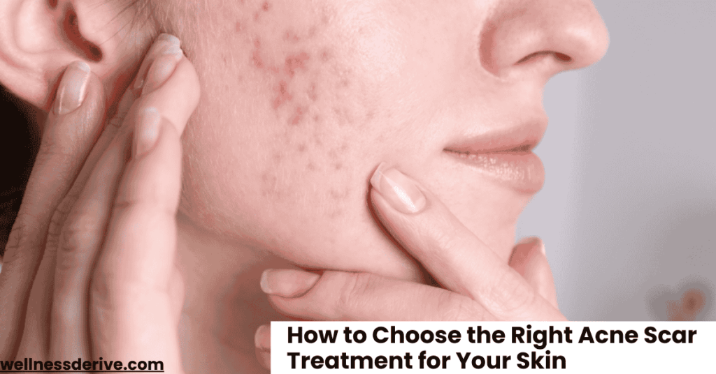 How to Choose the Right Acne Scar Treatment for Your Skin