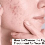 How to Choose the Right Acne Scar Treatment for Your Skin