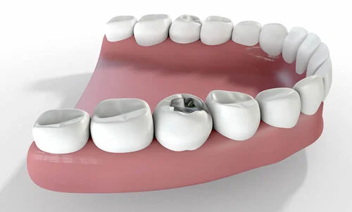 Symptoms of a Cavity on the Side of a Tooth