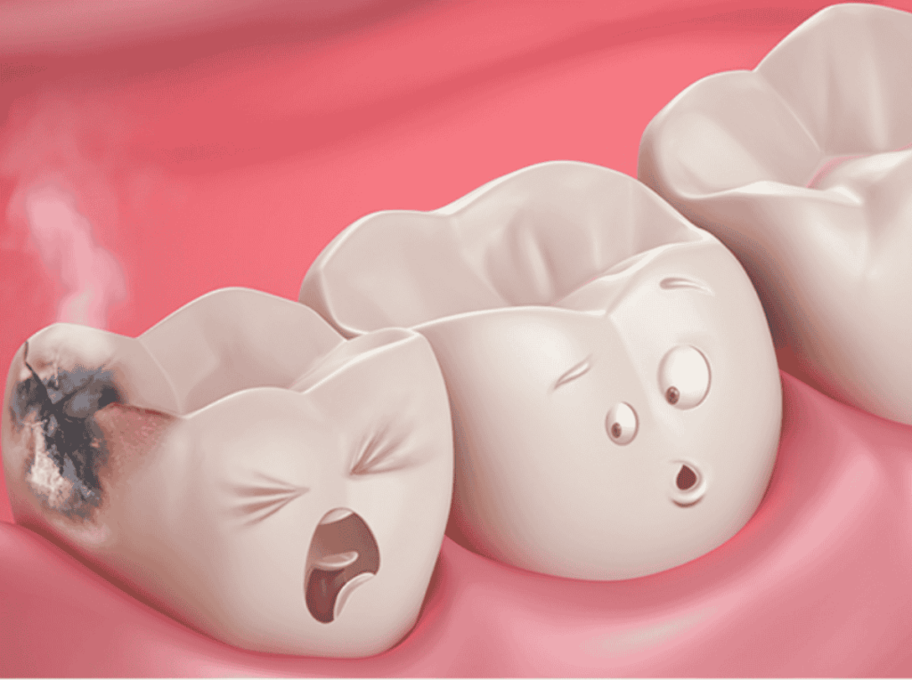 What Happens If You Ignore a Cavity on the Side of Your Tooth