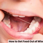 How to Get Food Out of Wisdom Tooth Hole Safely