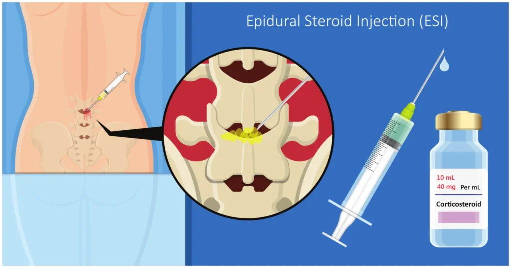 What Is an Epidural Steroid Injection